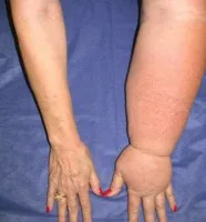 Lymphedema - fajok, okok, tünetek, kezelés