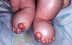 Lymphedema az alsó végtagok - kezelése, tünetek, okok (rövid szénláncú) Lymphedema az alsó végtagok - kezelése, tünetek, okok