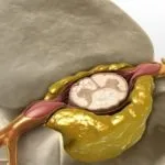 Bordaközi neuralgia tünetek és az otthoni kezelés (a tünetek) Bordaközi neuralgia tünetek és a kezelés otthon