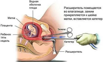 Menzesz után az abortusz, ha jönnek, mi határozza meg a szabály kóros állapotok (komplikáció) Havonta az abortusz után, amikor jönnek, hogy mi ez attól függ, mértéke, kóros állapotok