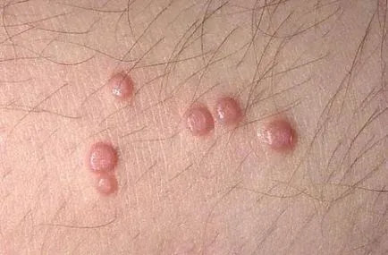 Kagyló az arcon, ami molluscum contagiosum felnőtteknél, hogyan lehet megszabadulni