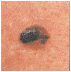 Veszélyes 6 mol jelek melanoma