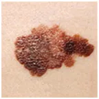 Veszélyes 6 mol jelek melanoma