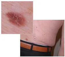 Veszélyes 6 mol jelek melanoma
