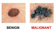 Veszélyes 6 mol jelek melanoma
