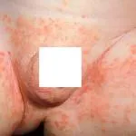 Pelenka dermatitis csecsemők - Okok, kezelés