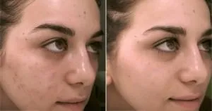 Arc peeling - ez egy kémiai, ultrahangos és mások előtt és után, hogyan kell csinálni