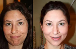 Arc peeling - ez egy kémiai, ultrahangos és mások előtt és után, hogyan kell csinálni
