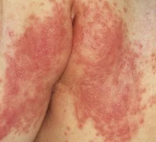 Pelenka deratit okuk a gyermekek számára, a tünetek, kezelési módszerek és a megelőzés (pelenka) Pelenka deratit oka van a gyermekek számára, tünetek, kezelési módszerek és a megelőzés