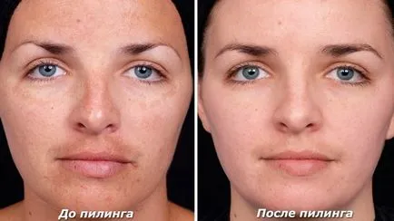 Arc peeling - ez egy kémiai, ultrahangos és mások előtt és után, hogyan kell csinálni