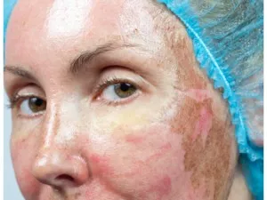 Az eljárás az arc peeling