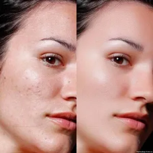 Az eljárás az arc peeling
