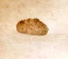 keratóza