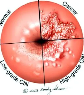 papilloma