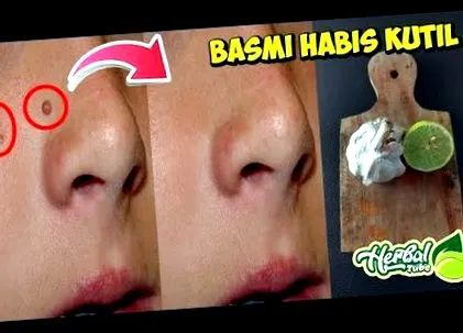papilloma