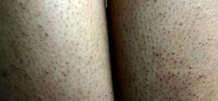 keratóza