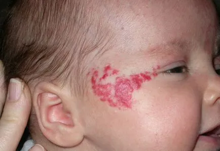 Anyajegyek az újszülöttek fotó okoz féle pigment foltok (foltok) Anyajegyek vannak képek újszülöttek féle okok öregségi foltok