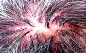 folliculitis folliculitis