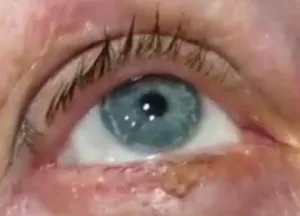 Seal vagy egy dudor a felső szemhéj azt chalazion, árpa, szemhéjgyulladás