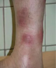 Erythema nodosum - Causes, tünetek és kezelés (ok) Erythema nodosum - okai, tünetei és kezelése
