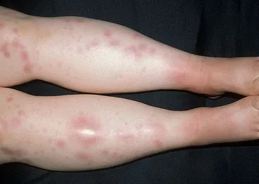 Csomóponti és erythema nodosum az alsó végtagok, amely (gömbgrafitos erythema alsó végtagok fotók) Csomóponti és erythema nodosum az alsó végtagok, amely