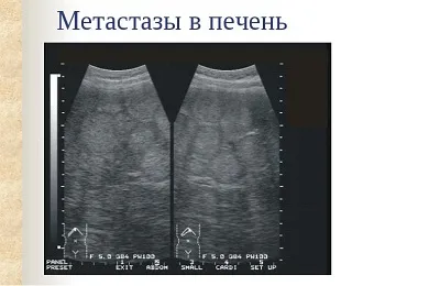 Uzi májban, amely megmutatja, a dekódolást és ráta paraméterek (máj) Uzi máj, amely megmutatja, dekódolás és aránya mutatók