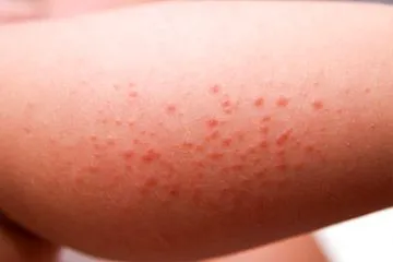 Fajtái és jellemzői használat allergiaellenes kenőcs (allergia) Típusai és jellemzői a használata antiallergiás kenőcsök