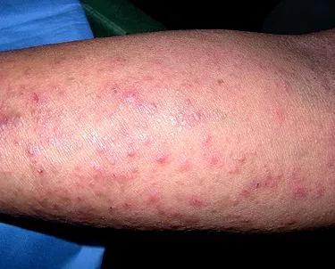 Fajtái és jellemzői használat allergiaellenes kenőcs (allergia) Típusai és jellemzői a használata antiallergiás kenőcsök