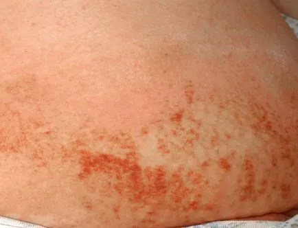 Típusai és jellemzői a használata antiallergiás kenőcsök (tumorok az emberi szervezetben) Típusai és jellemzői a használata antiallergiás kenőcsök