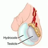 Hydrocele fiúkban tünetek, okok, kezelés a betegség