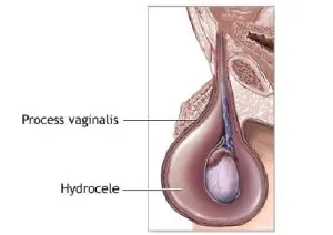 Hydrocele fiúkban tünetek, okok, kezelés a betegség
