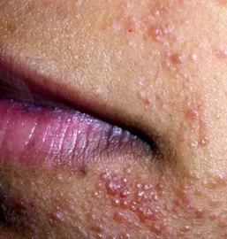 dermatitis