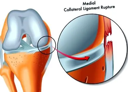 meniscus