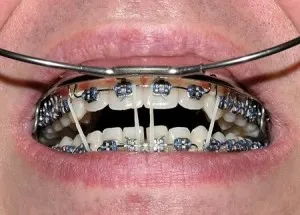 Miért tapadás Braces