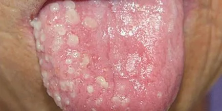 Sebek a nyelv, mint kezelni otthon, oka a (gyulladt) Sebek a nyelv, mint otthon is kezelhető, okai