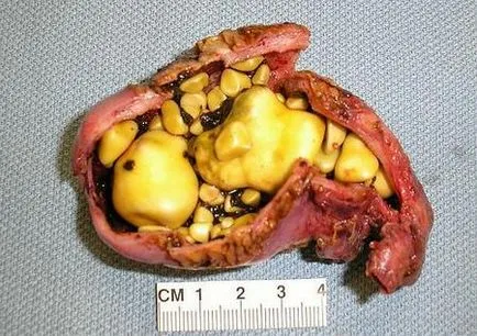 Cholelithiasis kezelt három különböző eljárással (kezelése epekövesség népi jogorvoslat LAPAROSZKÓPIA nélküli beavatkozás üzemszerűen) Cholelithiasis kezelt három különböző eljárással