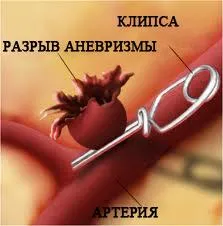 Agyi aneurizma - Causes, tünetek és kezelés (aneurizma) Agyi aneurizma - okai, tünetei és kezelése