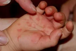 Allergia pálmák okoznak és kezelés (hámló bőr) Allergiás a tenyéren az okok és a kezelés
