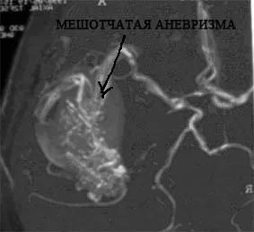 Agyi aneurizma - Causes, tünetek és kezelés (fej) Agyi aneurizma - okai, tünetei és kezelése