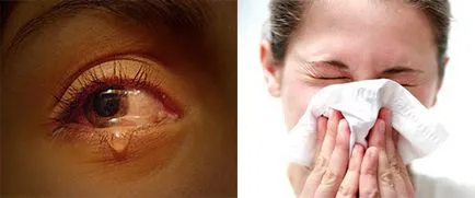Allergiás a fahéj tünetek, kezelés (allergiás tünetek fahéj) Allergiás a fahéj tünetek, kezelés