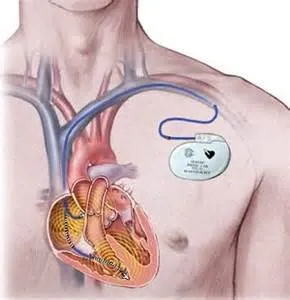 Bradycardia - Causes, tünetek és kezelés (kezelés) Bradycardia - okai, tünetei és kezelése