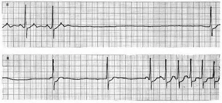 Bradycardia - Causes, tünetek és kezelés (tünetek) Bradycardia - okai, tünetei és kezelése