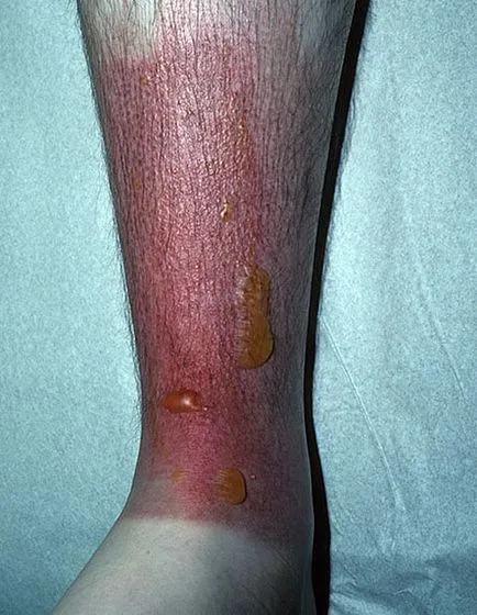 Hólyagos dermatitis patológia besorolás, okok és a tünetek, a kezelés elveit, fotók (hólyagos) Hólyagos dermatitis patológia besorolás, okok és a tünetek, a kezelés elveit, fotók