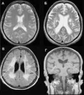 Az MRI eltér CT