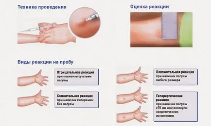 Miért Mantoux teszt a diagnózis tuberkulózis (do) Miért Mantoux teszt tuberkulózis diagnózis