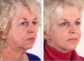 Facelift (face lift) technikák, vélemények és jellemzői