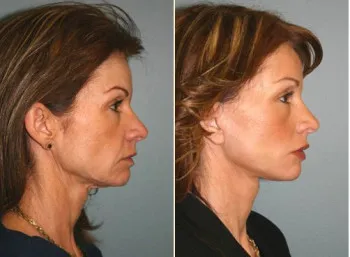 Facelift (face lift) technikák, vélemények és jellemzői