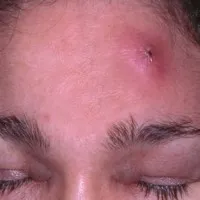 Herpes az arcon