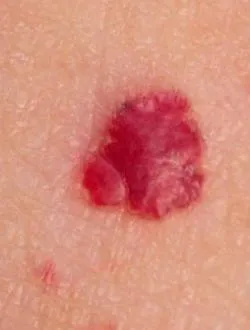 hemangiomas