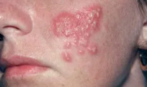 Herpes az arcon